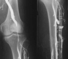 Ekstremitelerin varisli damarları için tanı seçenekleri