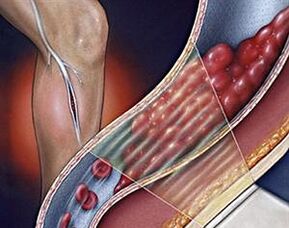 alt ekstremitelerin derin damarlarının varisli damarları